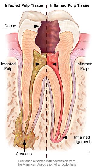 Tooth Pain - Likely causes and what can be done