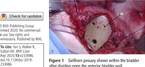 Figure 1 from Open removal of a migrated Gellhorn pessary and repair of ...