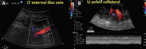 Endovascular Today - Diagnosis of Iliac Vein Obstruction With Duplex ...