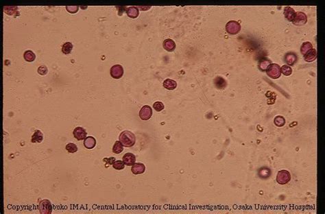 44 best images about Blood In Urine (Hematuria) on Pinterest | Occult, Assessment and Red blood ...