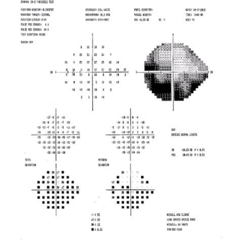 Glaucoma - Roswell Eye Clinic