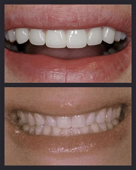 Esthetics Porcelain Veneers 20 | Rick Glassman, DDS, MAAFE