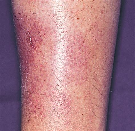 Primary Cutaneous Natural Killer/ T-Cell Lymphoma | Hematology | JAMA Dermatology | The JAMA Network