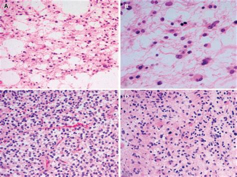 Low-grade gliomas: an update on pathology and therapy - The Lancet Neurology