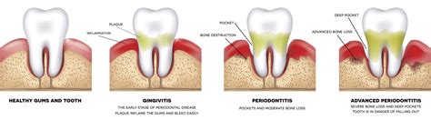 Bleeding Gums Cincinnati OH | Gum Disease | Gingivitis