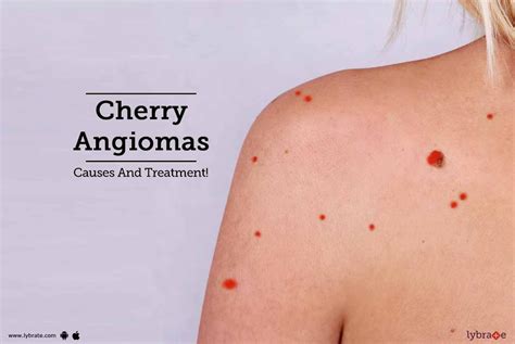 Cherry Angiomas - Causes And Treatment! - By Sakhiya Skin Clinic ...