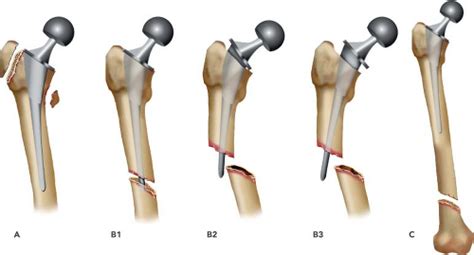 Periprosthetic Fractures of the Femur Associated with Hip Arthroplasty ...