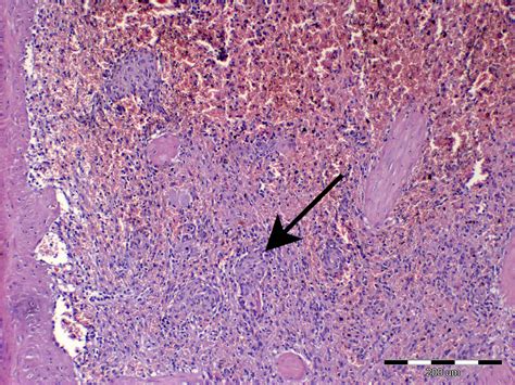 Metastasis of hemangiosarcoma cells to spleen (arrow). | Download ...