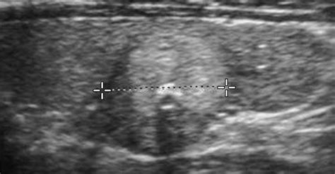 Sonographic Patterns of Benign Thyroid Nodules: Verification at Our Institution | AJR