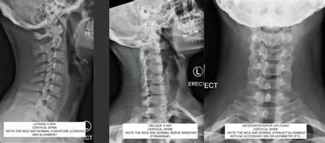 Spine Without Instrumentation | C.N.S. Neurosurgery