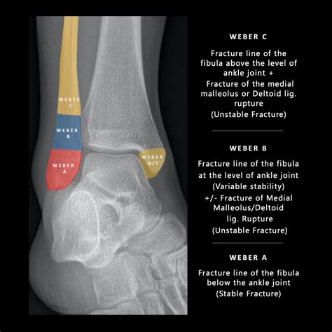 Weber Classification of Ankle Fractures - PULSE MD