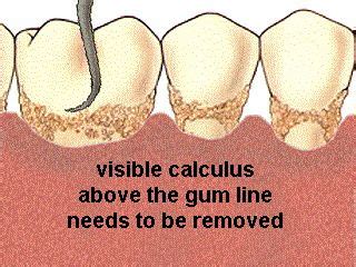 12 Calculus on Teeth ideas | dental, dental health, periodontitis