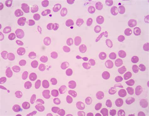 Thalassemia | Beta Thalassemia | MedlinePlus