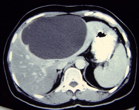 Liver Cyst 2736 Liver Cyst Non Neoplastic 14 | Surgery Photos