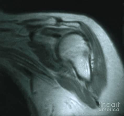 Mri Of Shoulder With Impingement Photograph by Science Source