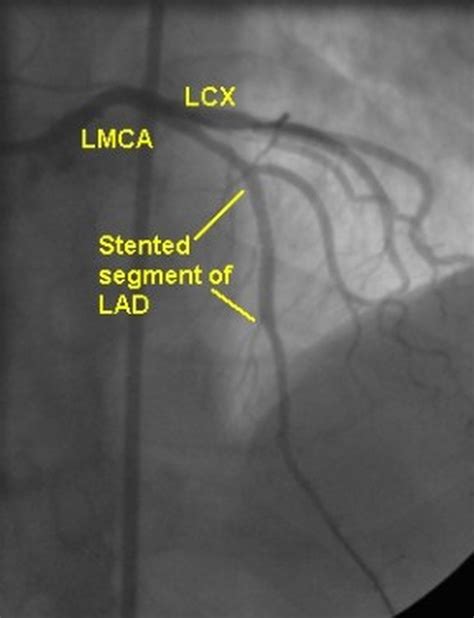 PTCA stenting of LAD total occlusion – All About Cardiovascular System ...