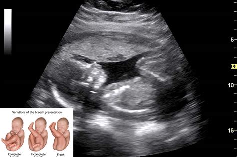 Additional routine ultrasound could eliminate undiagnosed breech presentation of babies - https ...