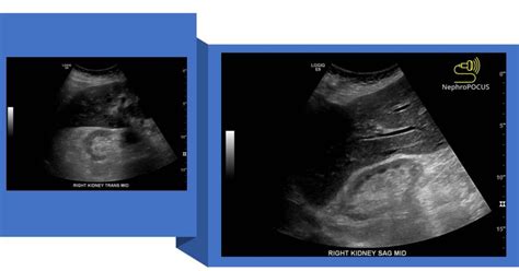 Increased renal cortical echogenicity does not always indicate chronic ...