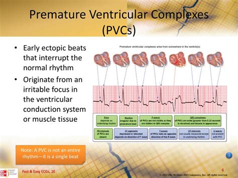 PPT - Ventricular Dysrhythmias PowerPoint Presentation, free download - ID:5204970