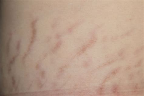 Stretch Marks — Causes, Treatment and Prevention. – Renita Rajan – Medium