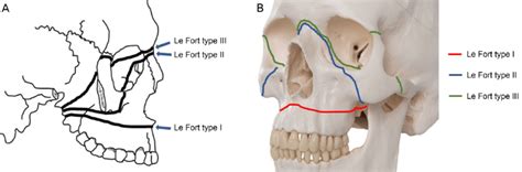 Types of Le Fort osteotomy (A, B). Thick black lines across the skull... | Download Scientific ...