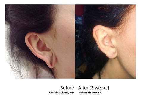 Expert Earlobe Repair Near Miami FL