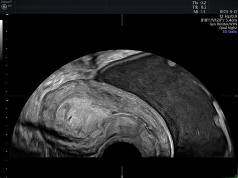 The Assessment, Diagnosis and Causes of Endometrial Cancer | Empowered ...