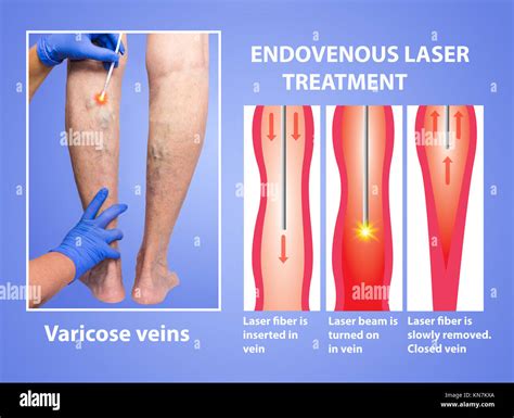 Varicose Veins. Endovenous laser treatment of female legs Stock Photo ...