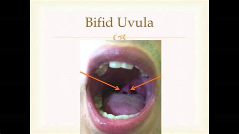 Bifid Uvula - YouTube