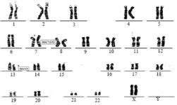 A Novel De Novo Chromosomal Insertion, 46 XX, ins(7:13)(p14; q14.2q21.1) is Related to the ...