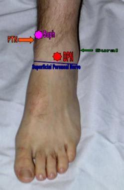 Plantar Nerve Block