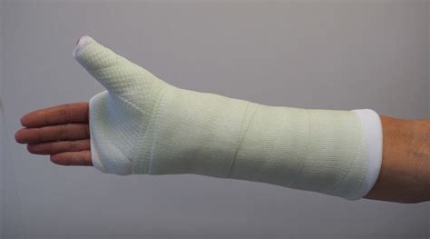 Fractura del hueso escafoides de la muñeca (Scaphoid Fracture of the Wrist) - OrthoInfo - AAOS