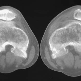 Example of a patient with squinting patella due to excess of tibial... | Download Scientific Diagram