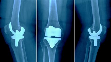 Knee Joint Replacement Devices