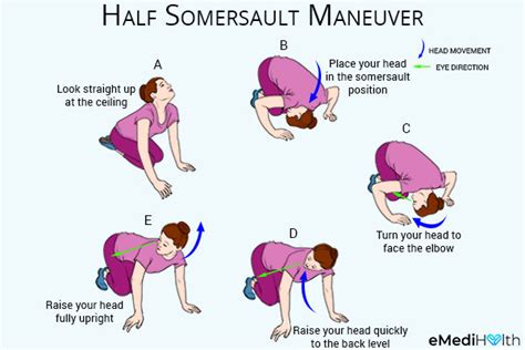 Get Epley Maneuver Vertigo Exercises Images