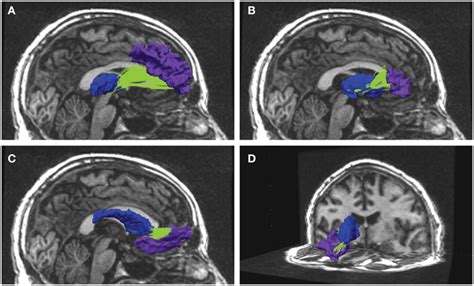 Examples from reconstructed frontal-subcortical fiber bundles in right ...