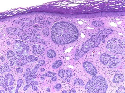 Squamous Cell Carcinoma Vs Basal Cell Carcinoma Histology