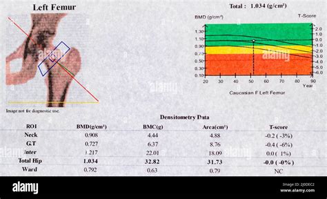 DEXA densitometry report of left femoral scan; diagram and curve of ...