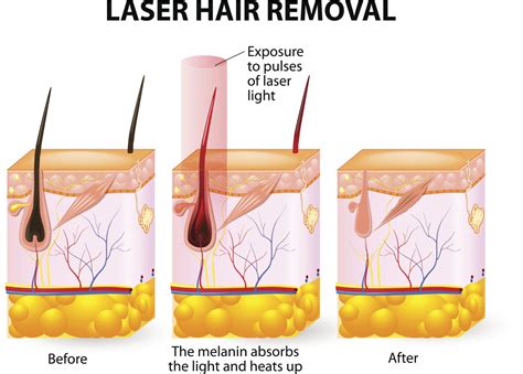 Is Laser Hair Removal Painfull? How Much and Why it Hurts