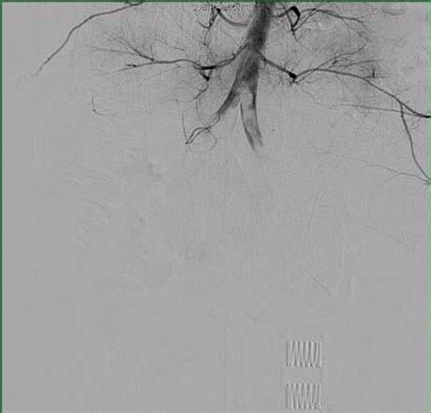 Pelvic crush injury requiring hemicorporectomy | Trauma Surgery & Acute ...