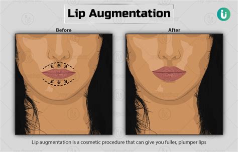 Lip Augmentation: Procedure, Purpose, Results, Cost, Price, Indications, Recovery