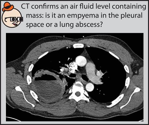 Empyema Chest X Ray | My XXX Hot Girl