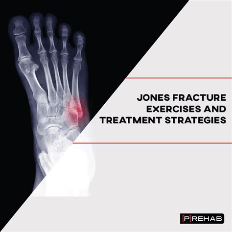 Jones Fracture Exercises and Treatment Strategies | [P]rehab