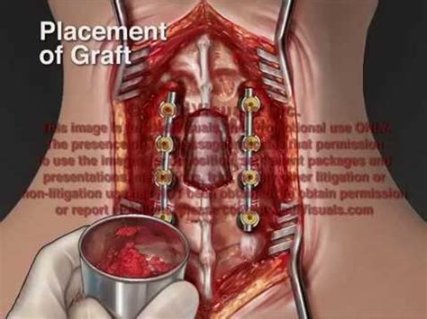 Posterior Cervical Fusion - YouTube