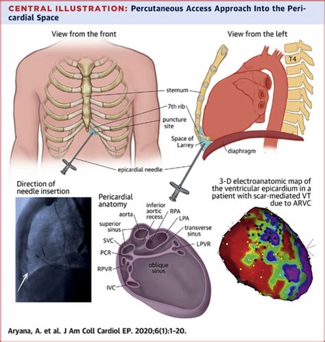 Pericardial Window Procedure Steps