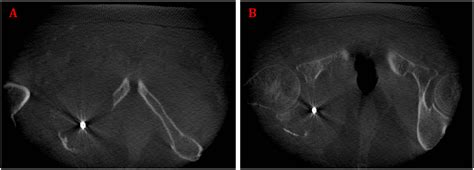 Favorable outcomes of navigated percutaneous ablation and cementoplasty of bone metastasis in ...