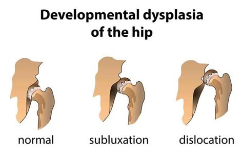 Canine Hip Dysplasia – Facts and Symptoms – German Shepherd Country