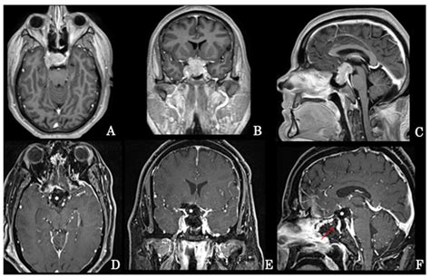 Brain Sciences | Free Full-Text | Giant Non-Functioning Pituitary ...