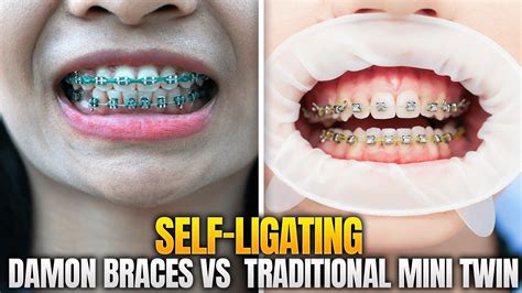 Self Ligating / Damon Braces vs Traditional Mini Twin