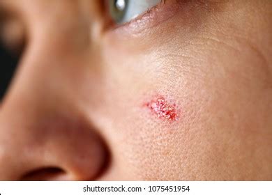 Skin Abrasion Images, Stock Photos & Vectors | Shutterstock